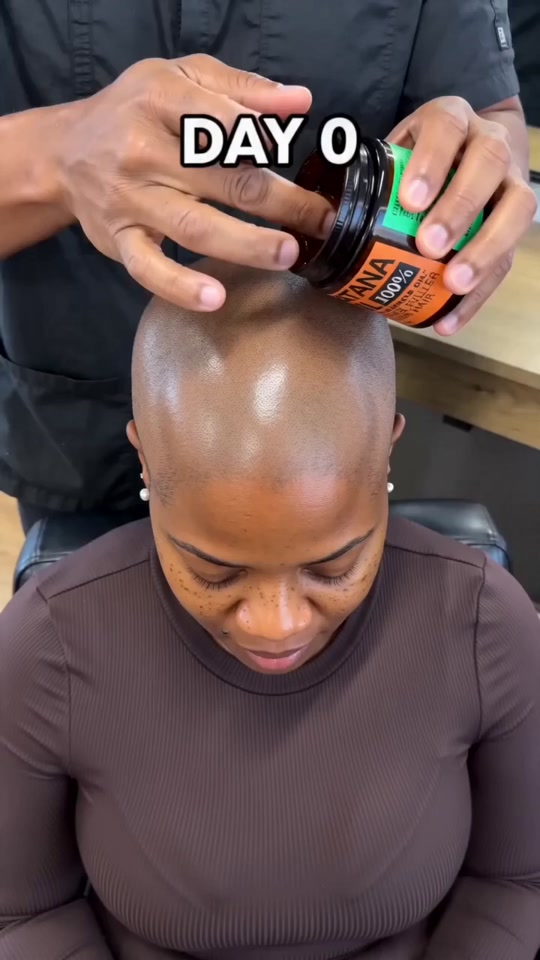 She shaved it down at 38 - watch 5 months of Batana Oil  DAY 0 to DAY...